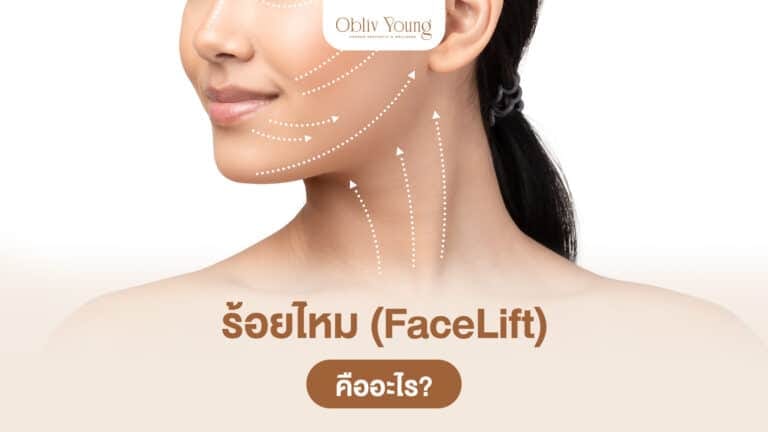ร้อยไหม (FaceLift) คืออะไร