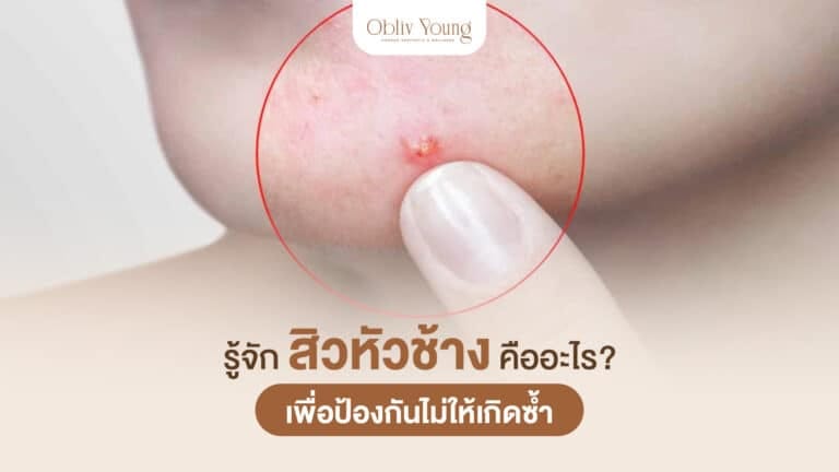 รู้จักสิวหัวช้าง คืออะไร เพื่อป้องกันไม่ให้เกิดซ้ำ