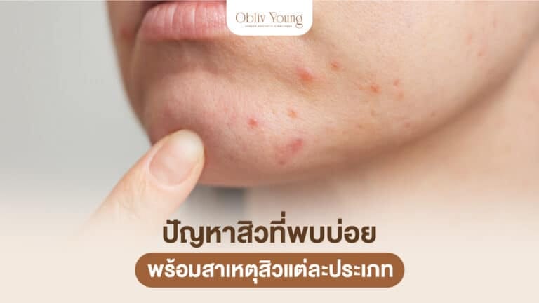 Comedonal Acne: Closed vs Open Comedones and What to Do