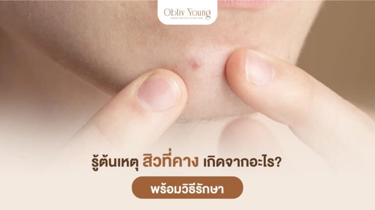 รู้ต้นเหตุ สิวที่คางเกิดจากอะไร พร้อมวิธีรักษา
