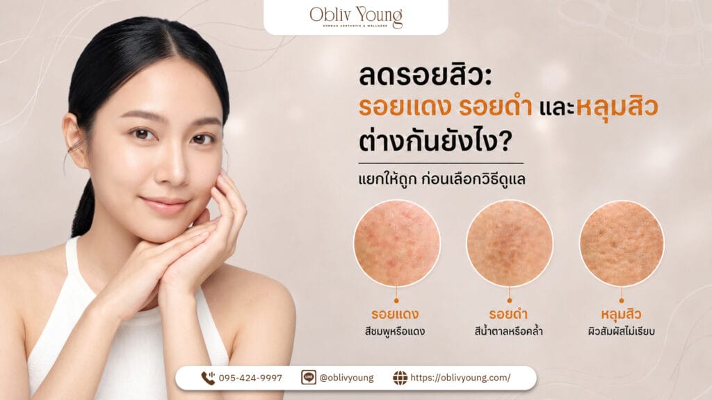 ลดรอยสิว รอยแดง รอยดำ และหลุมสิว Obliv Young Clinic