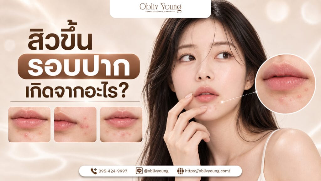 สิวขึ้นรอบปากเกิดจากอะไร และเมื่อไรควรพบแพทย์