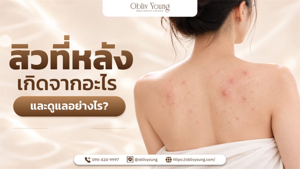 สิวที่หลังเกิดจากอะไร และดูแลอย่างไร