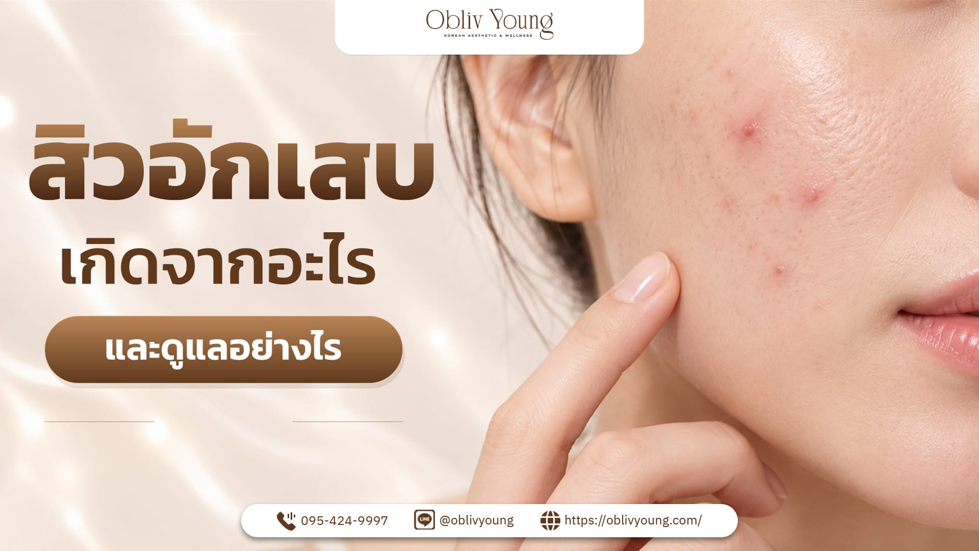 สิวอักเสบเกิดจากอะไร และดูแลอย่างไร