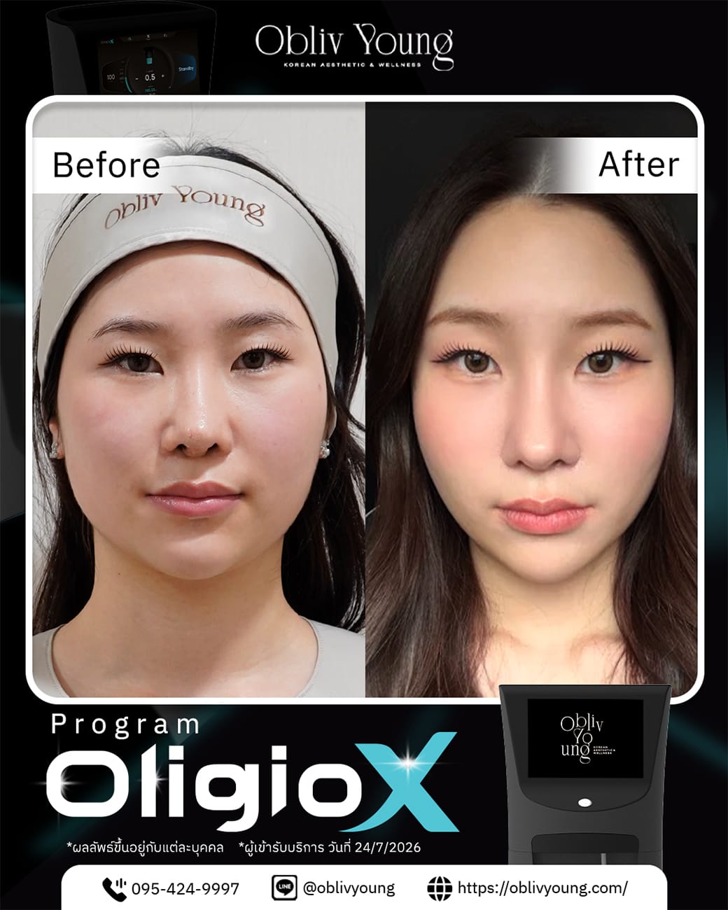 OligioX Before and After result