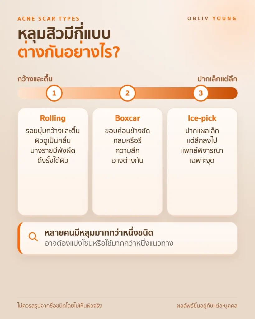 หลุมสิว Rolling Boxcar และ Ice-pick ลักษณะของแต่ละชนิด ตั้งแต่รอยบุ๋มกว้างและตื้นถึงปากแผลเล็กแต่ลึก