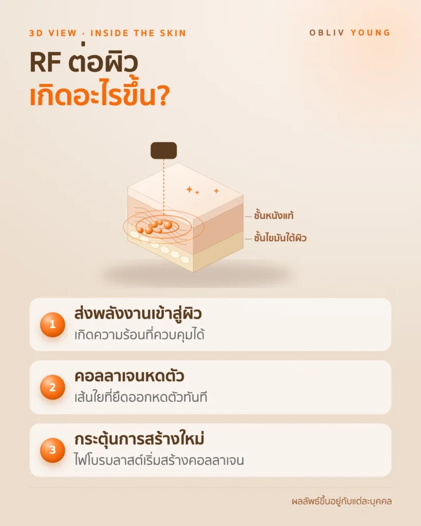 หลักการทำงานของ RF ต่อผิว: ความร้อนในชั้นหนังแท้ การหดตัวของคอลลาเจน และการสร้างใหม่