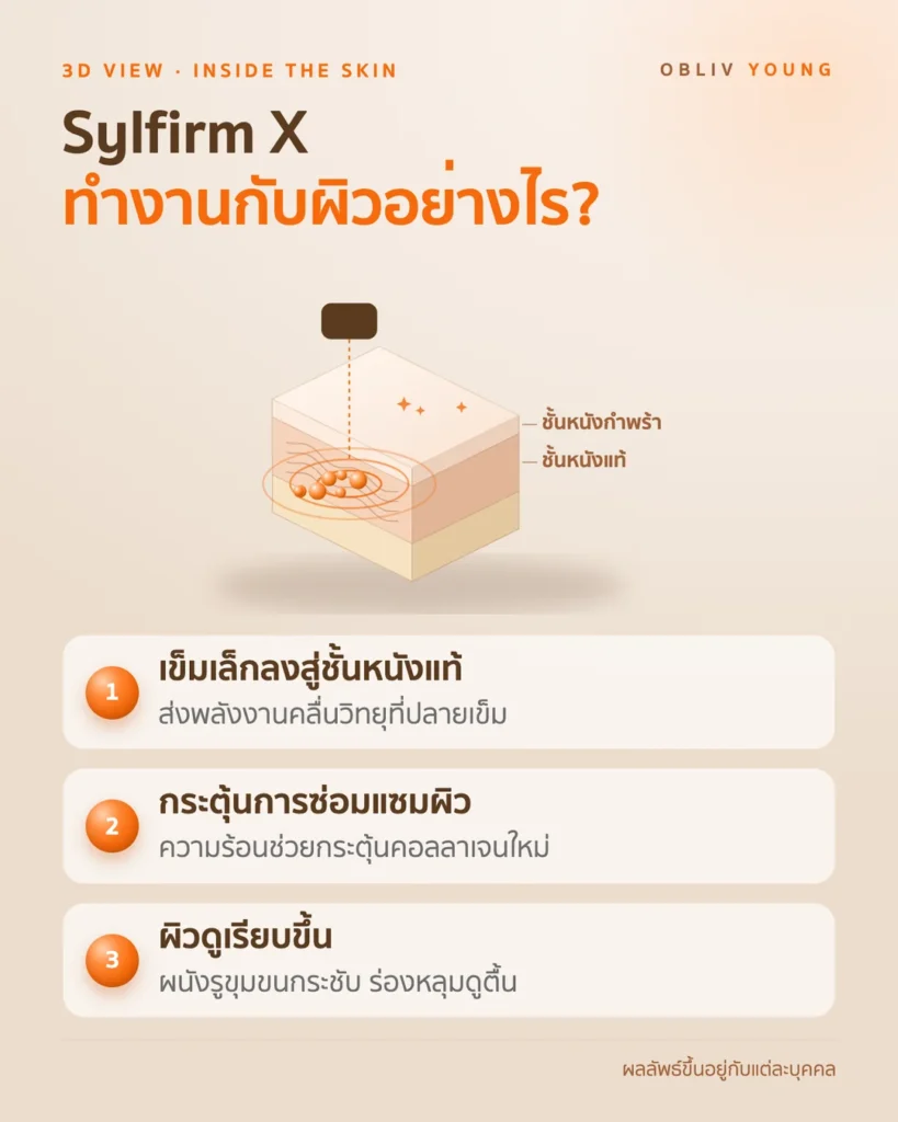 Sylfirm X ใช้เข็มและคลื่นวิทยุส่งพลังงานสู่ชั้นหนังแท้เพื่อกระตุ้นคอลลาเจน